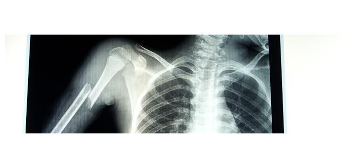 X-Ray of Zac's broken arm, showing displaced fracture of humerus.