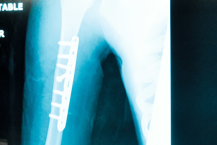 X-Ray