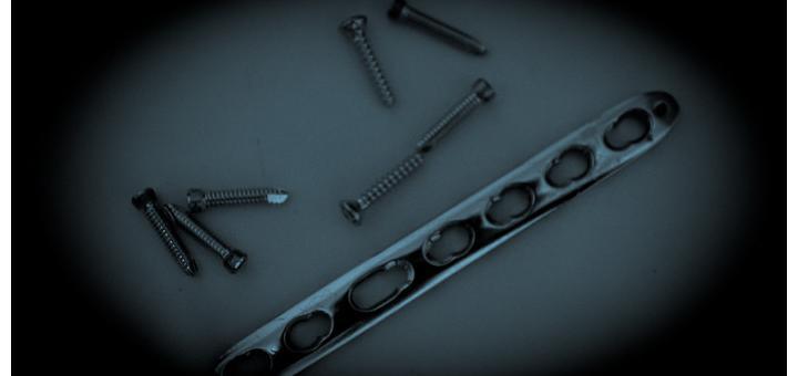 Plate and screws removed from Zac's arm.